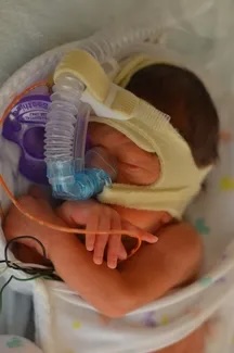A premature infant rests in an incubator with a CPAP breathing mask and feeding tube, swaddled in a hospital blanket.