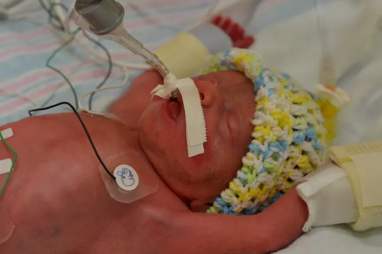 A premature newborn with red-tinted skin lies on a hospital bed, intubated and wearing a crocheted hat, receiving intensive care.