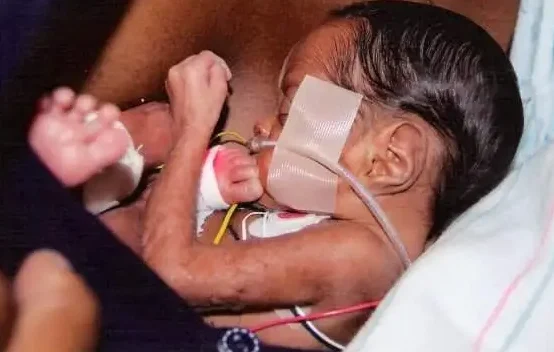 A premature newborn with medical tubes and monitoring equipment rests on a blanket, receiving specialized care.